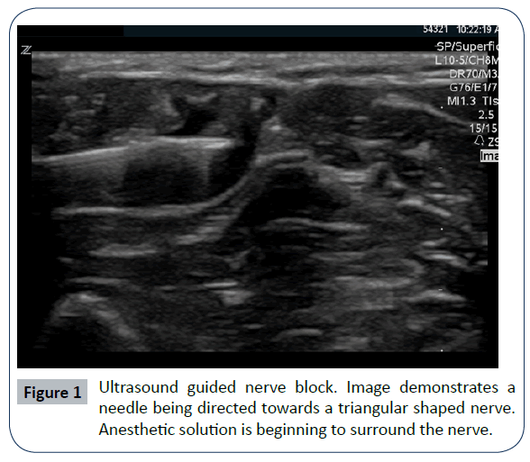 hospital-medical-management-ultrasound-guided-nerve-block